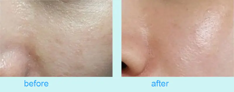 Microneedling Dr Pen
