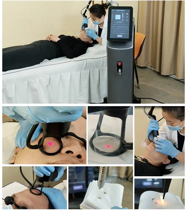 Co2 Laser Face Treatment